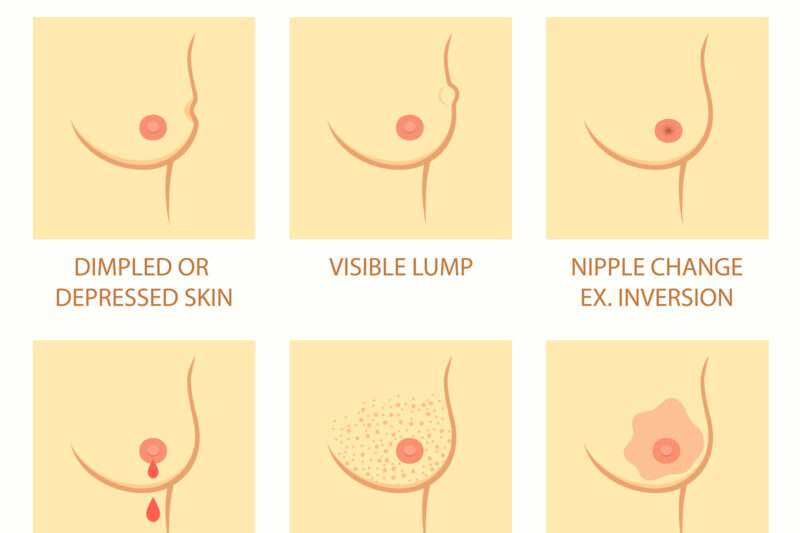 Ketulan Pada Payudara Yang Wanita Wajib Ambil Tahu