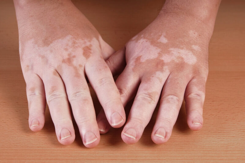 Vitiligo Sopak – Memahami Punca, Rawatan Terkini dan Peranan Nutrisi Dalam Pengurusan Kulit