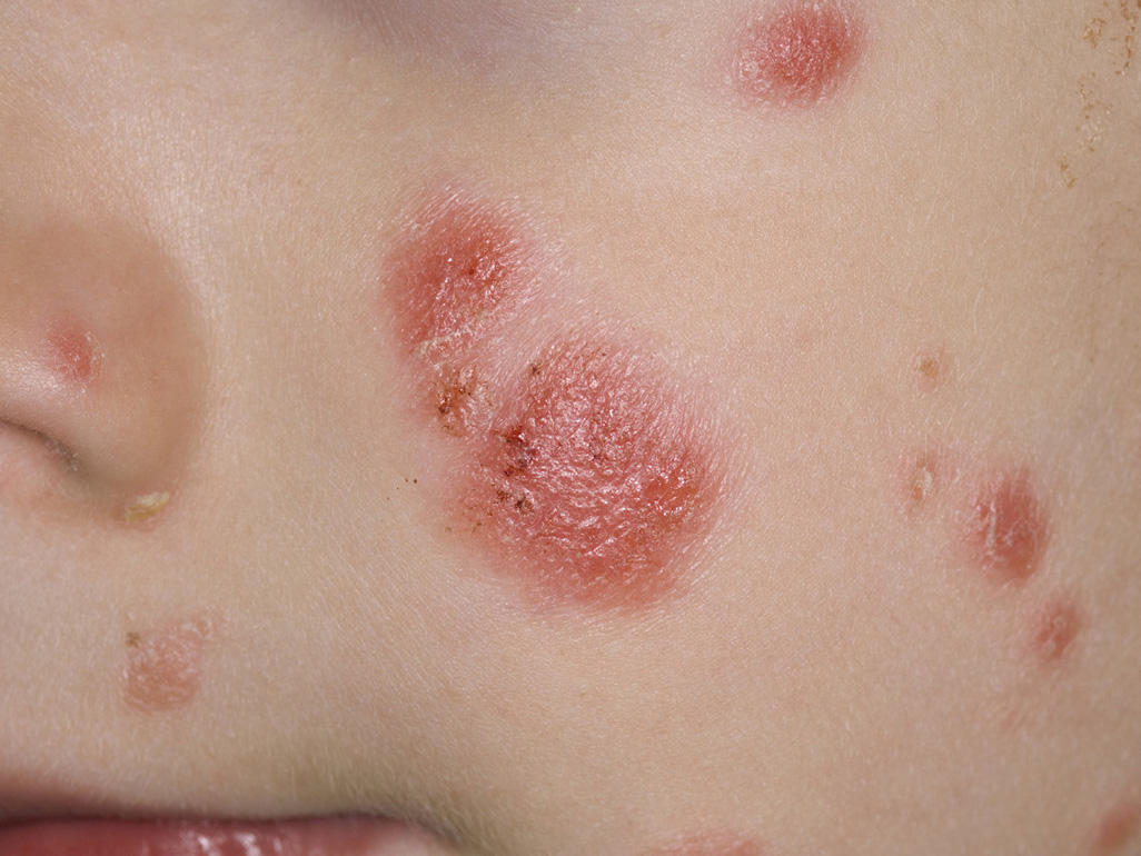 vivix shaklee psoriasis