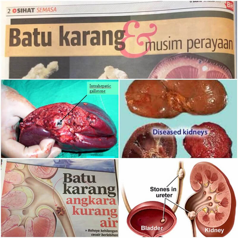 batu karang sakit saluran kencing jangkitan kuman vivix shaklee