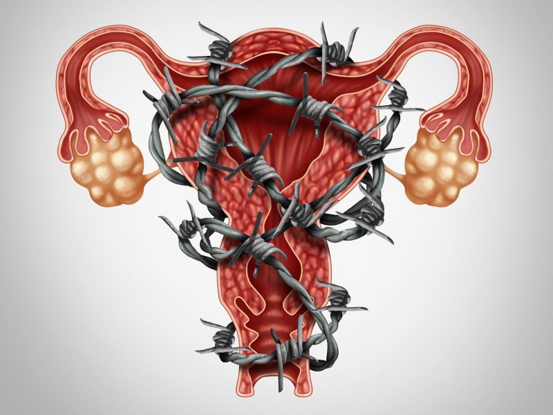 endometriosis