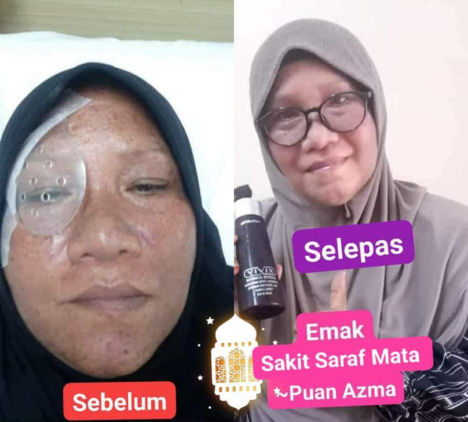 vivix sakit saraf mata emak
