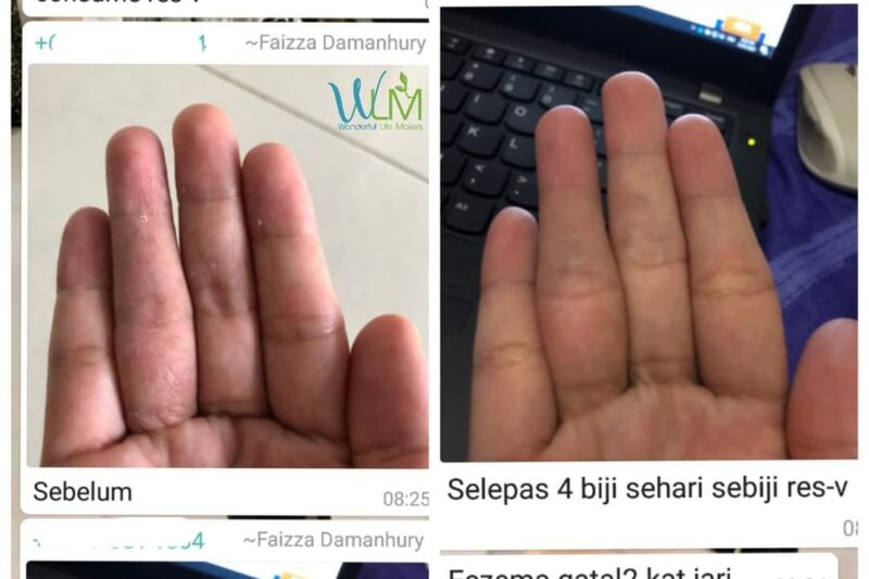 Polifenol ResV Merawat Eczema ?
