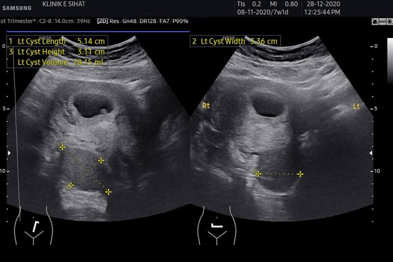 Pengurusan Cyst dan Fibroid – Adakah Vivix dan ResV Shaklee Membantu ?