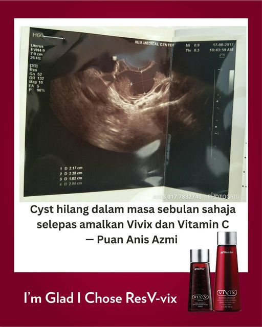 cyst hilang sebulan