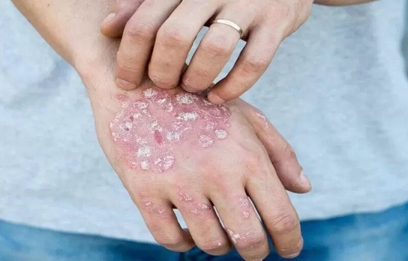 Tips Merawat Ekzema – Supaya Tidak Berparut Tebal dan Hitam Kembali Yakin Tanpa Rasa Rendah Diri