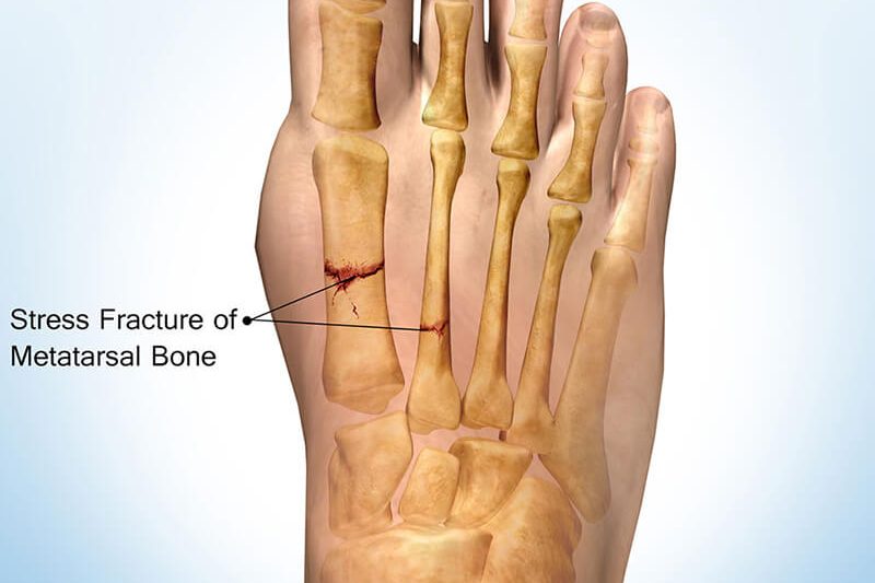 Tulang Retak Sambung Semula ?