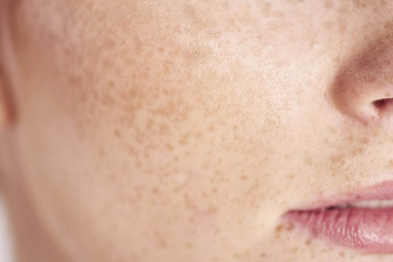 Jeragat Pigmentasi – Merawat Dari Dalam Dengan Kajian Terkini, Kuasa Resveratrol