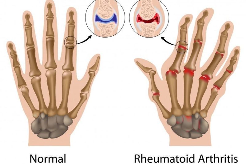 Rheumatoid Artritis: Punca, Simptom, dan Harapan Baharu Melalui Nutrisi
