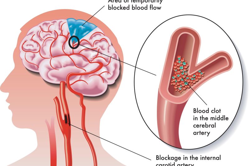 Strok Ringan: Amaran Senyap yang Membawa Padah dan Kuasa Polifenol Sebagai Penawar Semulajadi