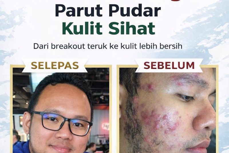 Vivix Shaklee: Rahsia Kulit Bersih, Jerawat Hilang & Parut Pudar dari Dalam